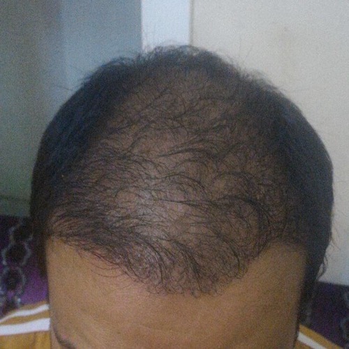 تجربة زراعة الشعر بتركيا في اثيكانا كلينك ( تحديث الشهر السادس ) P_443c3mdv5