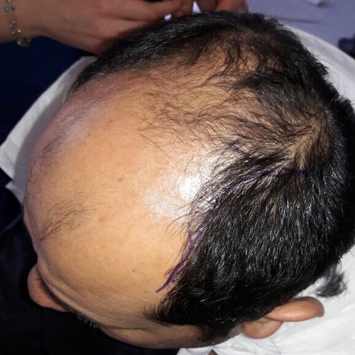 تجربة زراعة الشعر بتركيا في اثيكانا كلينك ( تحديث الشهر السادس ) P_443kz8j61