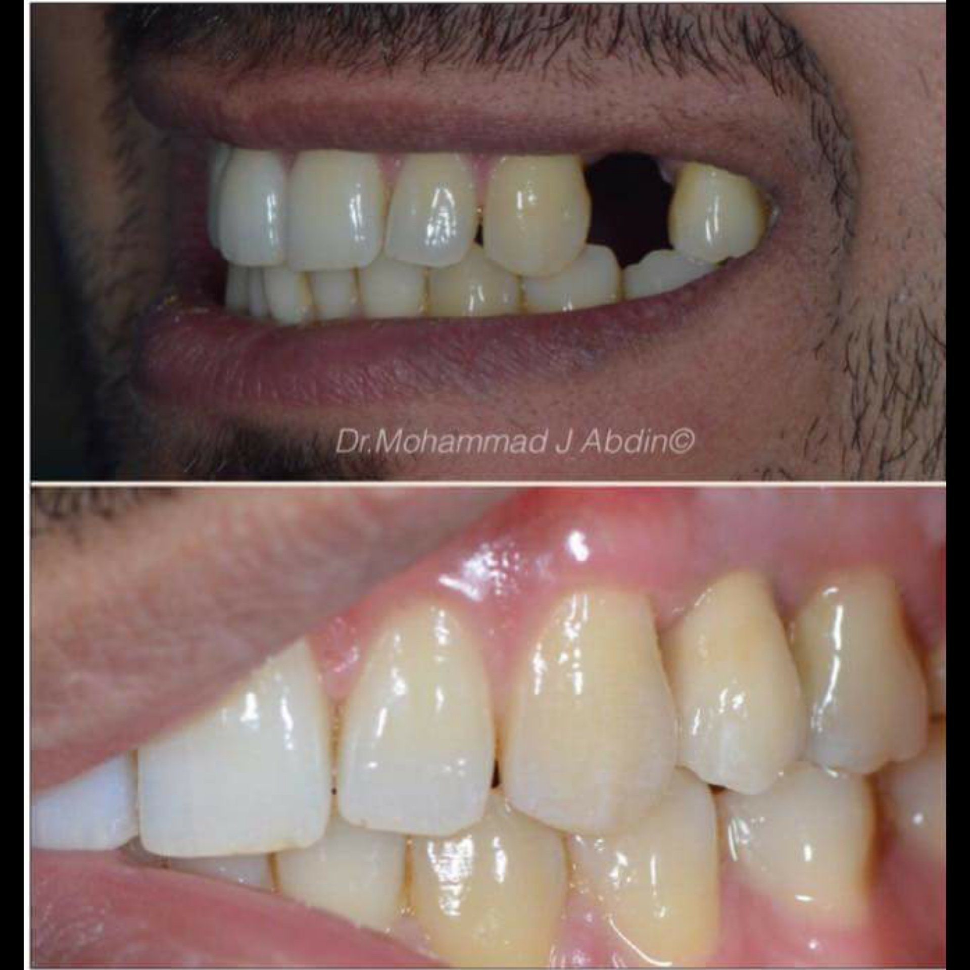 د.محمد عابدين أخصائي تركيبات الأسنان الثابته و المتحركة ، تجميل وزراعة الأسنان P_7384ih8c2